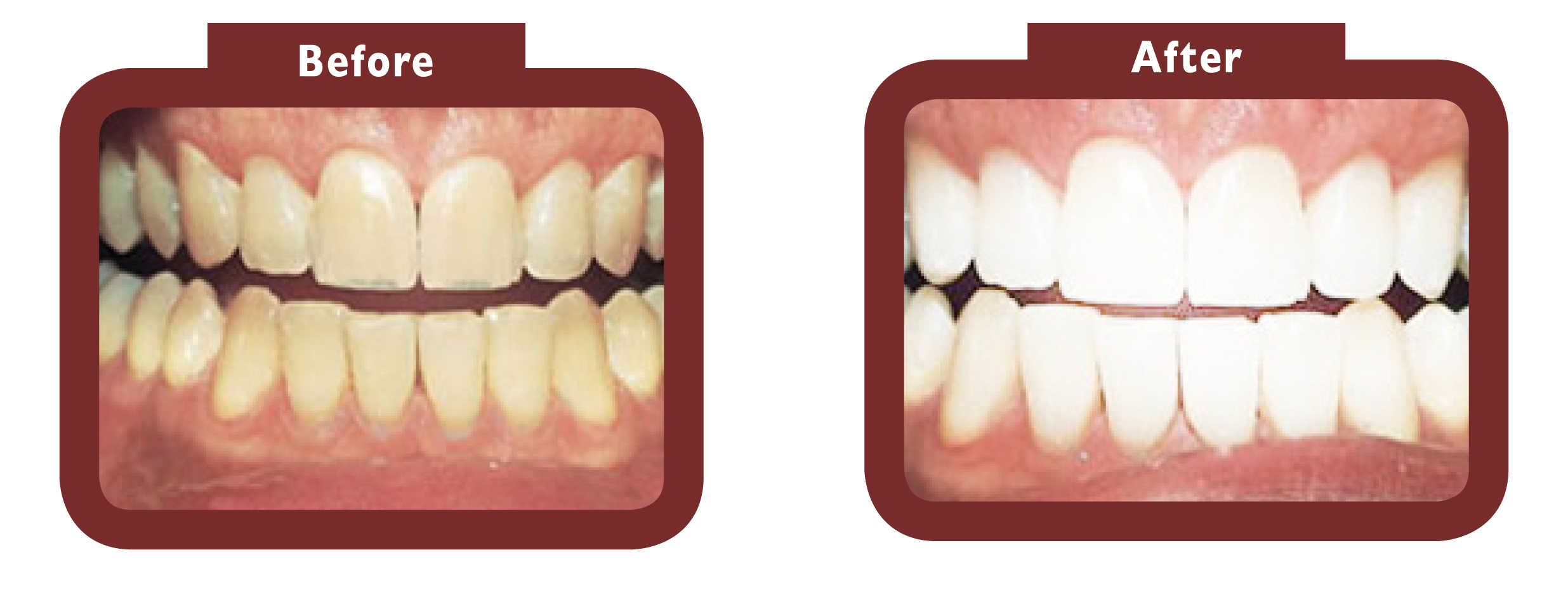 before and after teeth whitening - LA TEETH Southampton