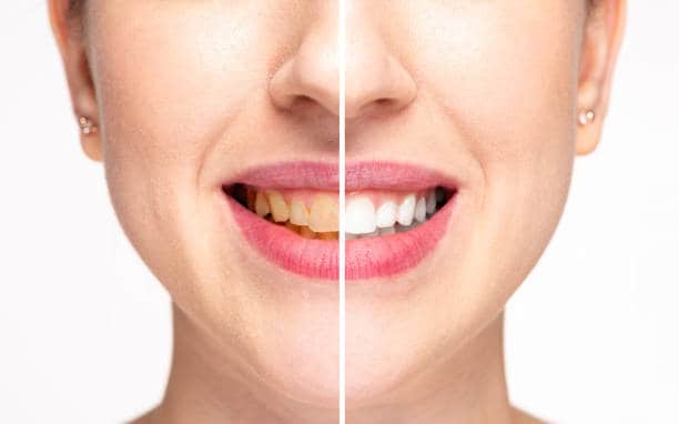 Teeth Whitening Milton Keynes Southampton