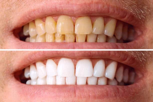 Laser White For Ever Bright – Get a Brighter, Whiter Smile with LA Teeth Whitening Southampton