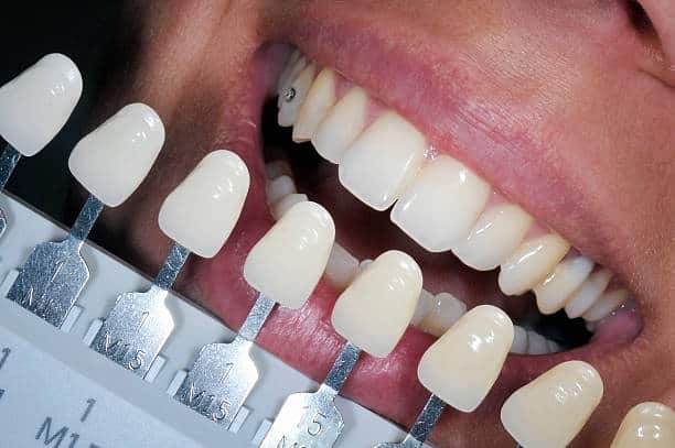 Get Natural and Stunning Smile with Teeth Whitening Results from LA Teeth Whitening Southampton