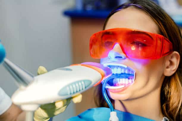 Simplifying Teeth Whitening: A Comprehensive Guide Southampton