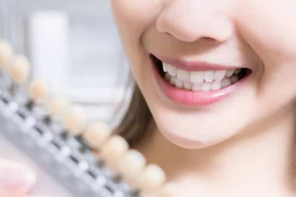 Teeth Whitening Kings Norton Southampton