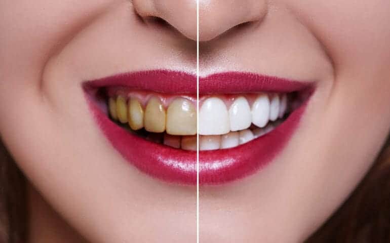 Teeth Whitening Ascot Windsor Southampton