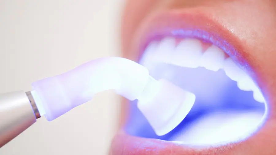 Teeth Whitening Aylesbury Southampton