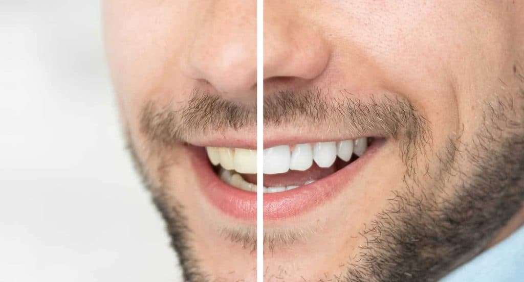 Teeth Whitening Bedfordshire Southampton